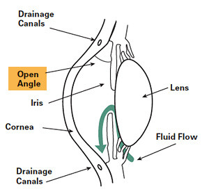 Open-angle Glaucoma - Coastal Eye Surgeons